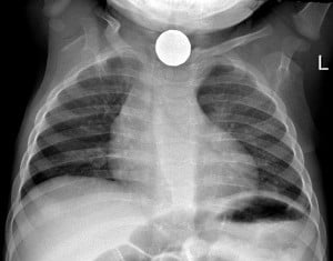 צילום רנטגן ותמונת המטבע כפי שצולמה מתוך האנדוסקופ