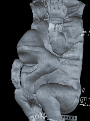 הדמיית ה-CT  של התינוקות הסיאמיים