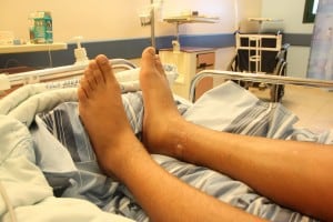 סימן ההכשה והנפיחות נראים עדיין לעין/ רגלו הימנית של עידו (צילום: בית החולים הלל יפה)