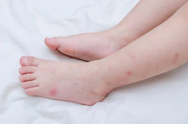 Mosquito bites sore on baby legs
